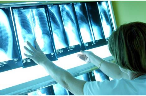 Cancer du poumon : Tagrisso réduit de moitié le risque de décès
