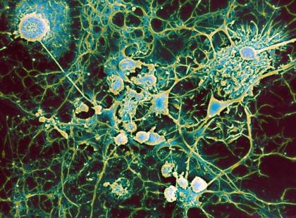 Destruction des oligodendrocytes de chaque cellule gliale (rond) due à une sclérose en plaques. Microscopie Electronique à Balayage (MEB)